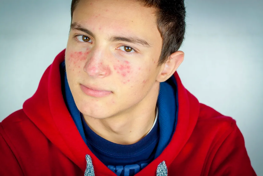 Stop Popping YOUR Pimples!