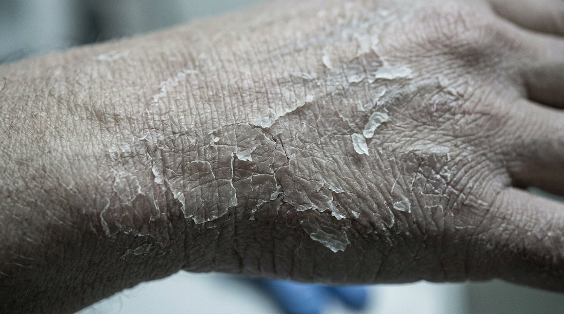 Extreme close-up of severely dry and flaking skin on the back of a hand showing skin barrier damage