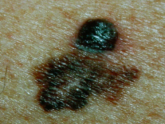 Malignant melanoma skin cancer - early detection by board certified dermatologist