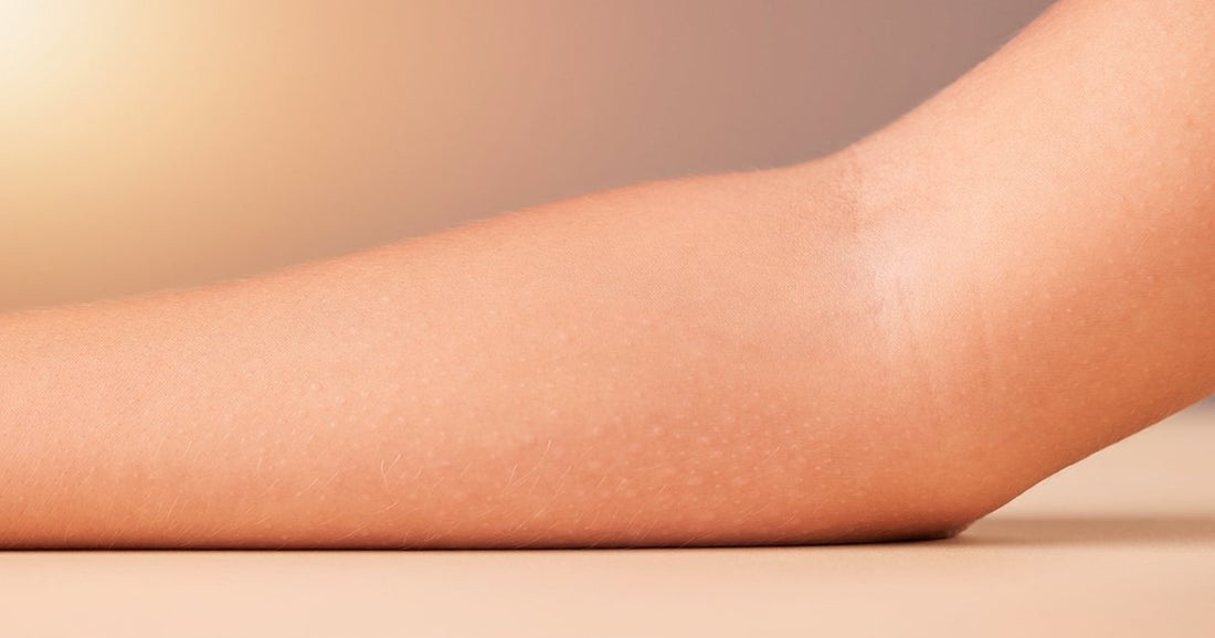 Get Rid of MRSA — The Dermatologist's Guide