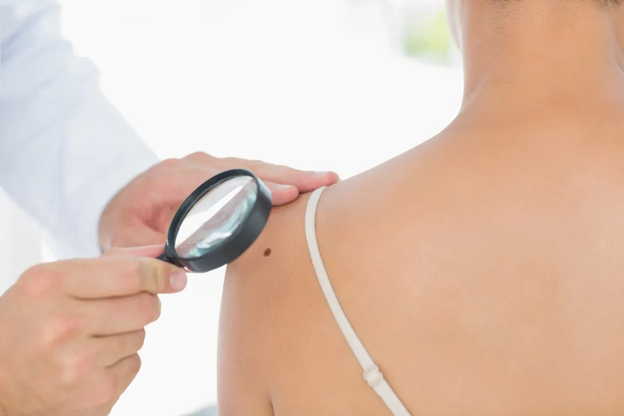 Early Detection of Skin Cancer: What You Need to Know