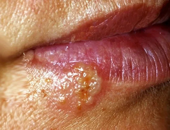 Understanding Herpes Simplex Virus (HSV) Infections: A Comprehens
